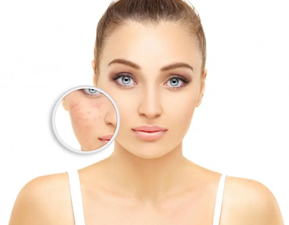 Join us for Giving The Best Facials for Acne with Amazing Positive Outcomes-Mediterranean Beauty